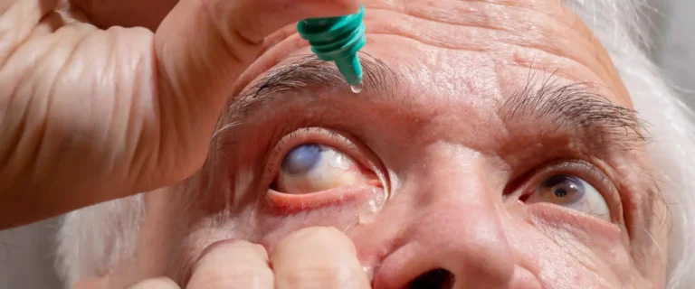 Gotas para el glaucoma utilizadas para reducir la presión intraocular