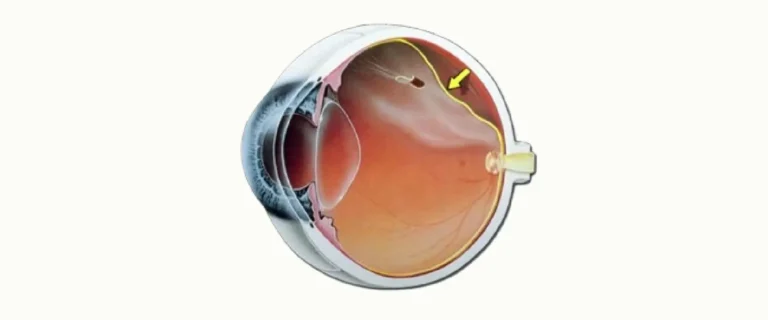 Desprendimiento de retina como urgencia oftalmológica que afecta la visión
