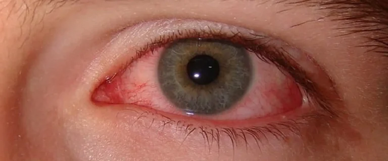 Ojo seco y alteraciones en la superficie ocular por falta de lubricación