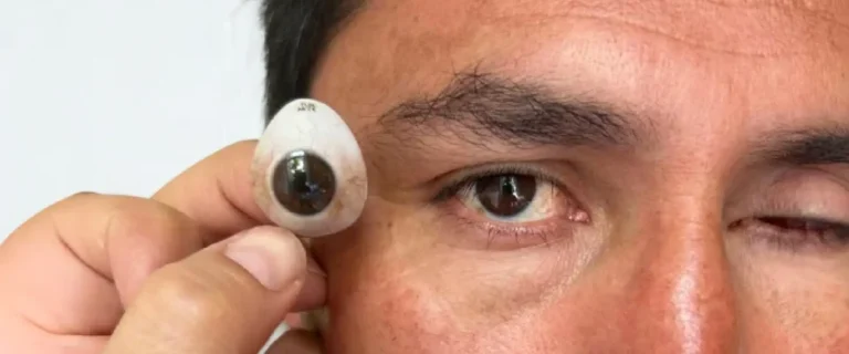 Enucleación ocular y adaptación de prótesis ocular