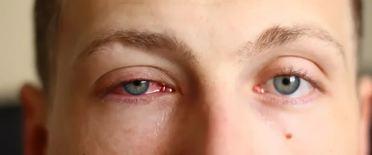 Inflamaciones oculares asociadas a enfermedades de la superficie ocular